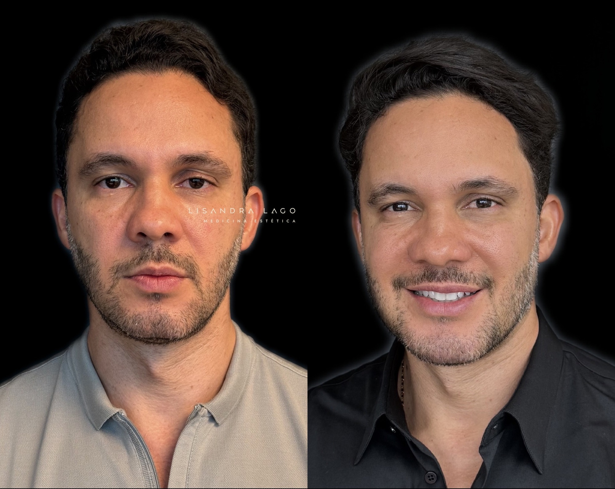 Resultado individualizado de tratamento facial