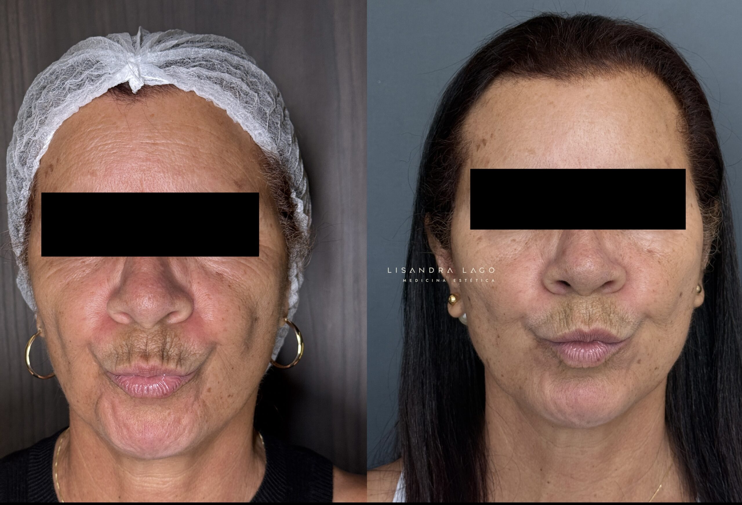 Antes e depois de tratamento facial realizado pela Dra. Lisandra Lago