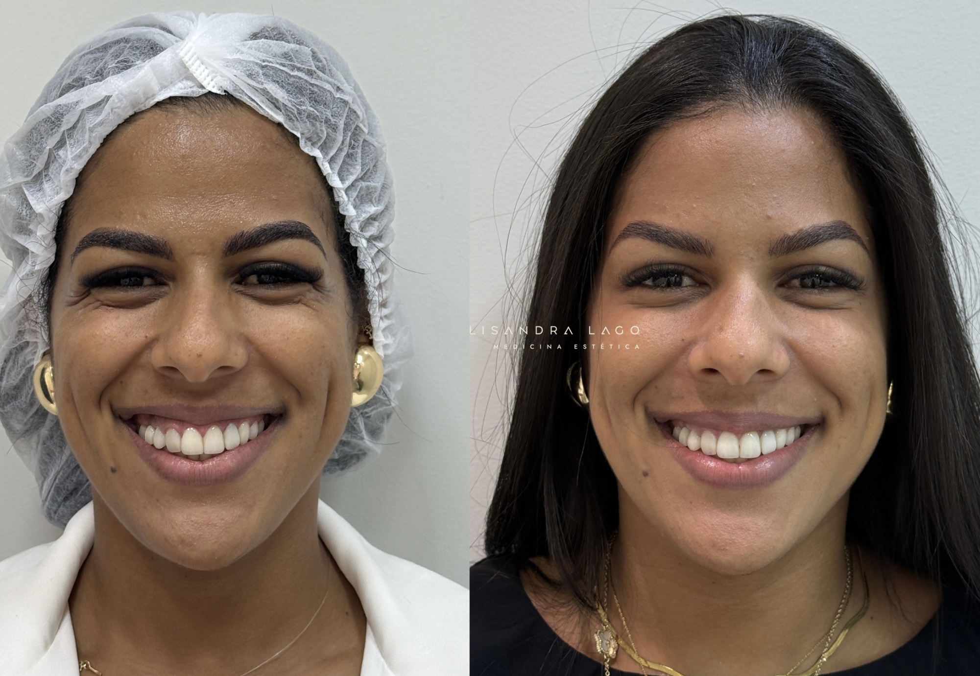 Resultado de procedimento estético facial