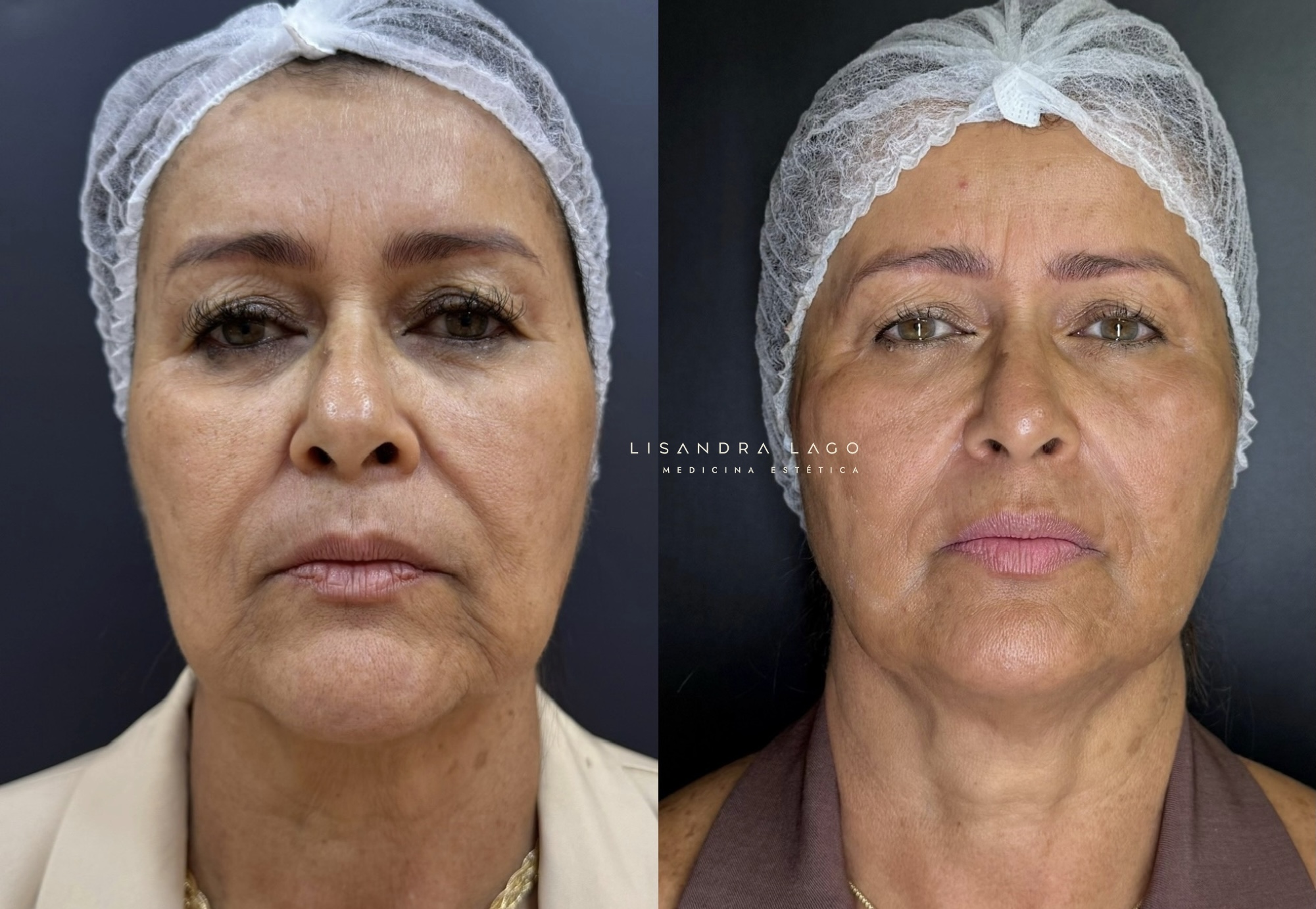 Resultado natural de tratamento facial