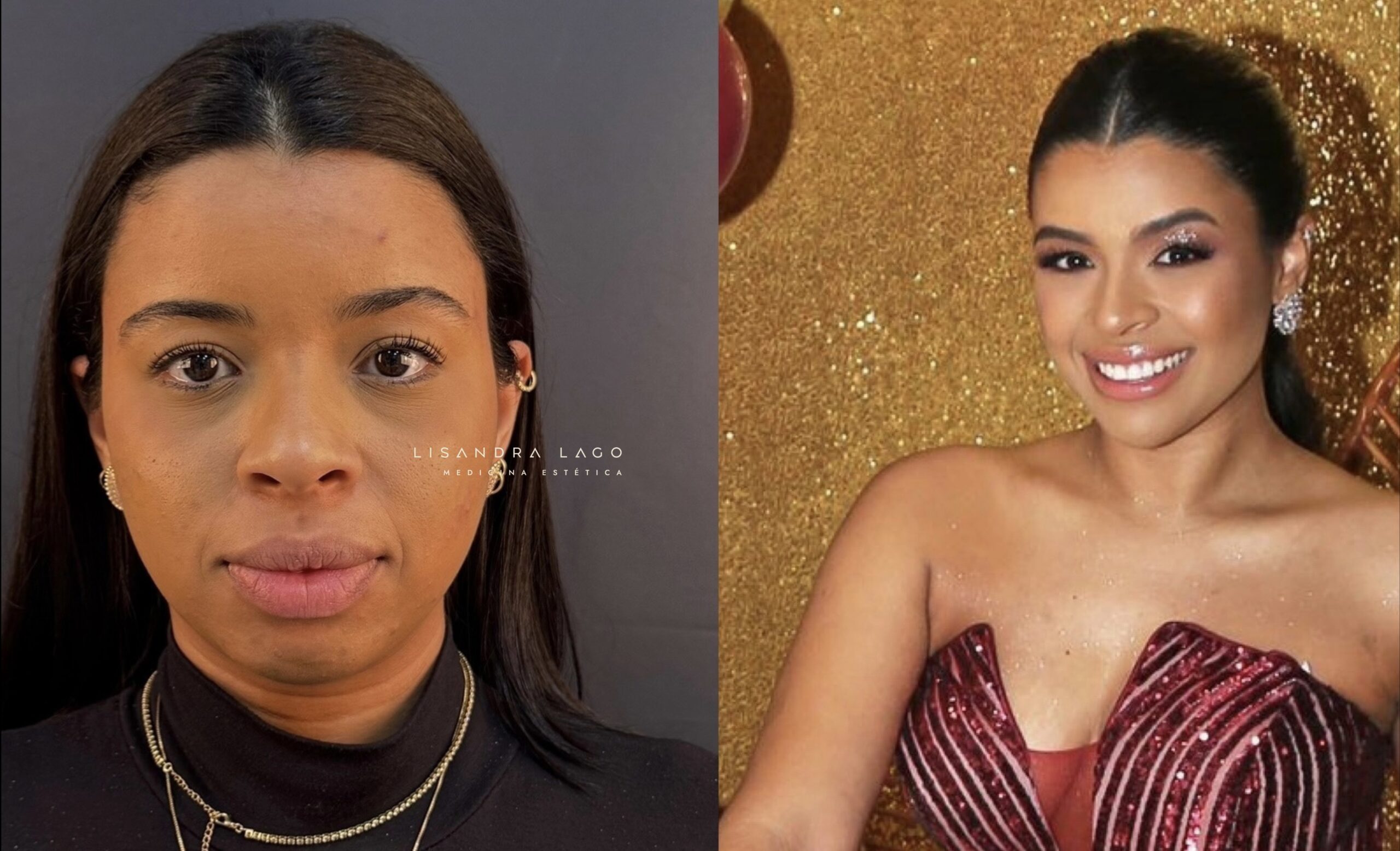 Resultado de tratamento facial realizado pela Dra. Lisandra Lago