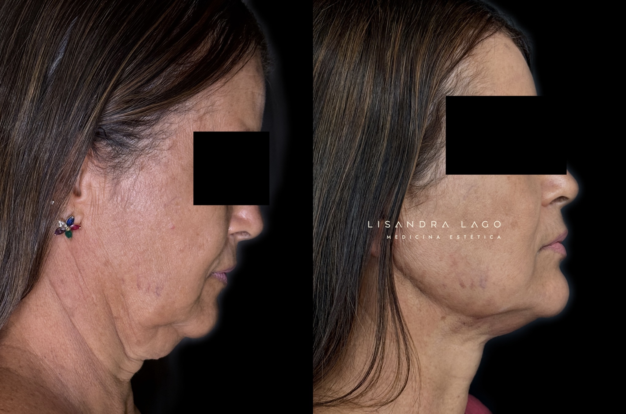 Resultado individualizado de tratamento facial