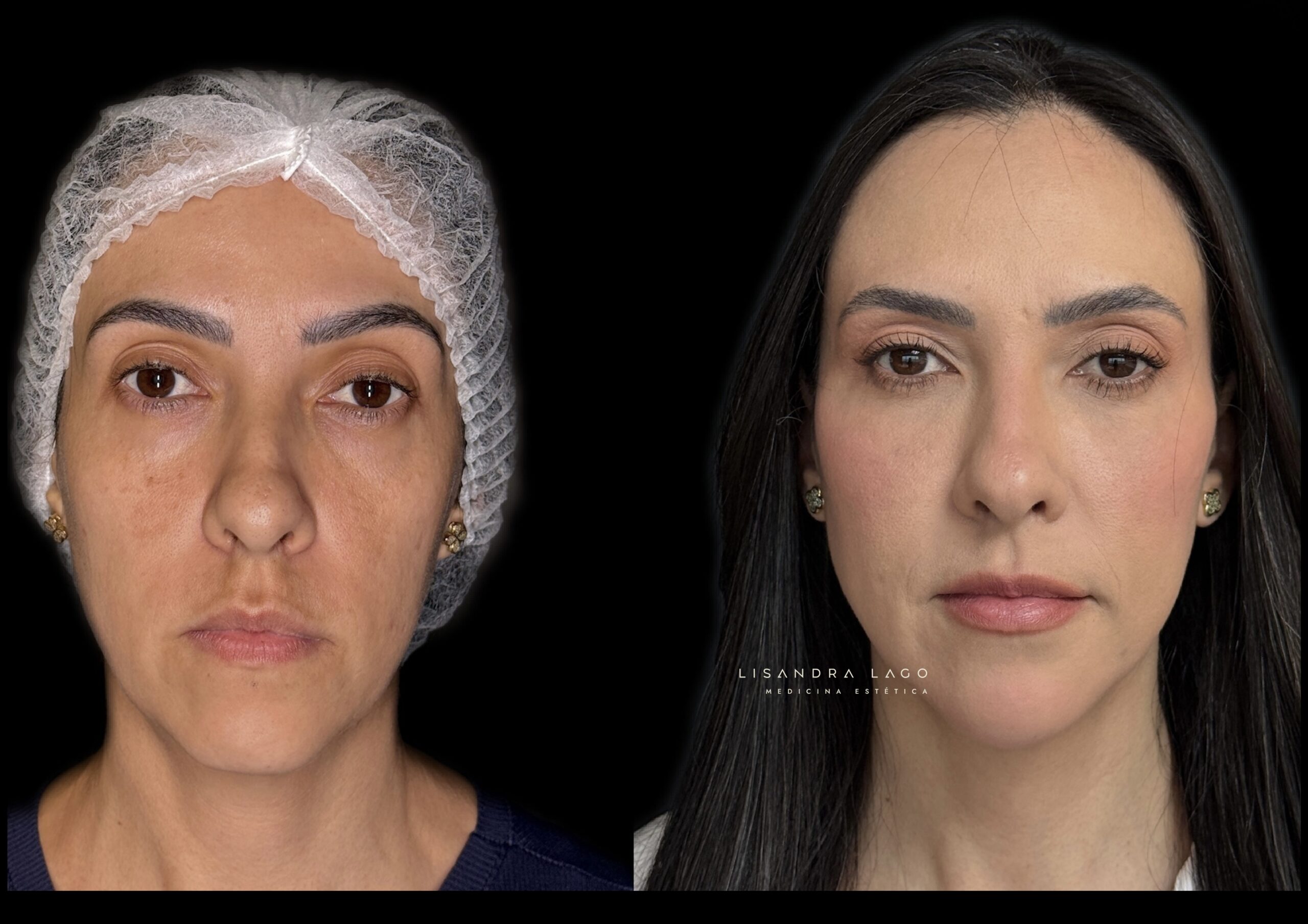Antes e depois de tratamento facial realizado pela Dra. Lisandra Lago