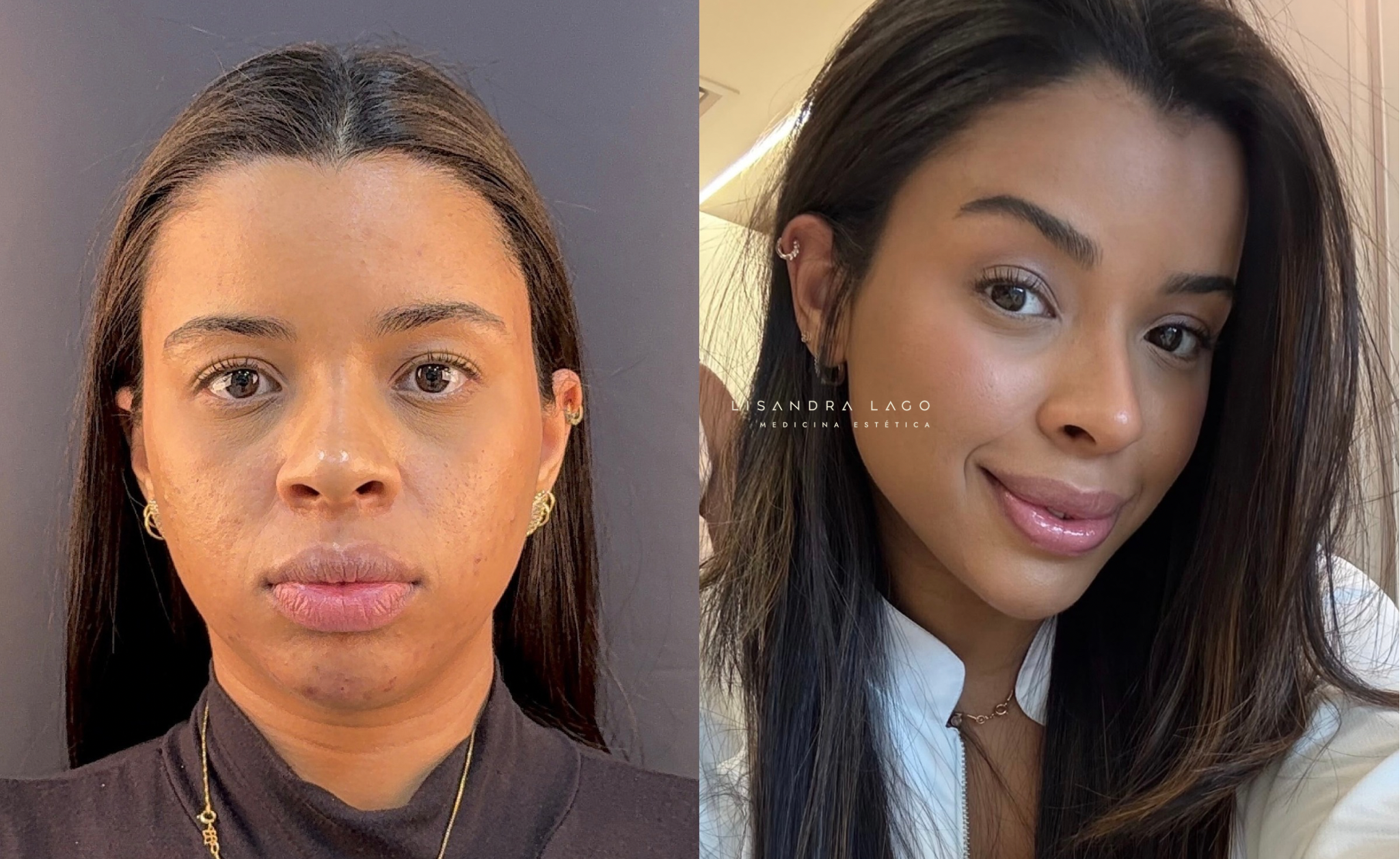 Resultado de tratamento facial realizado pela Dra. Lisandra Lago