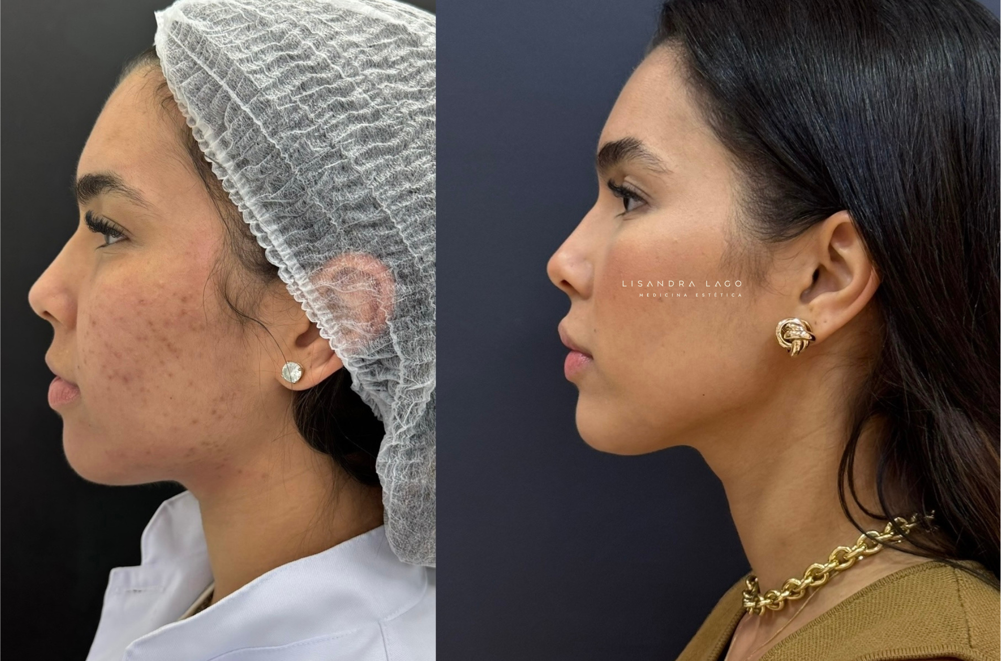 Resultado natural de tratamento facial