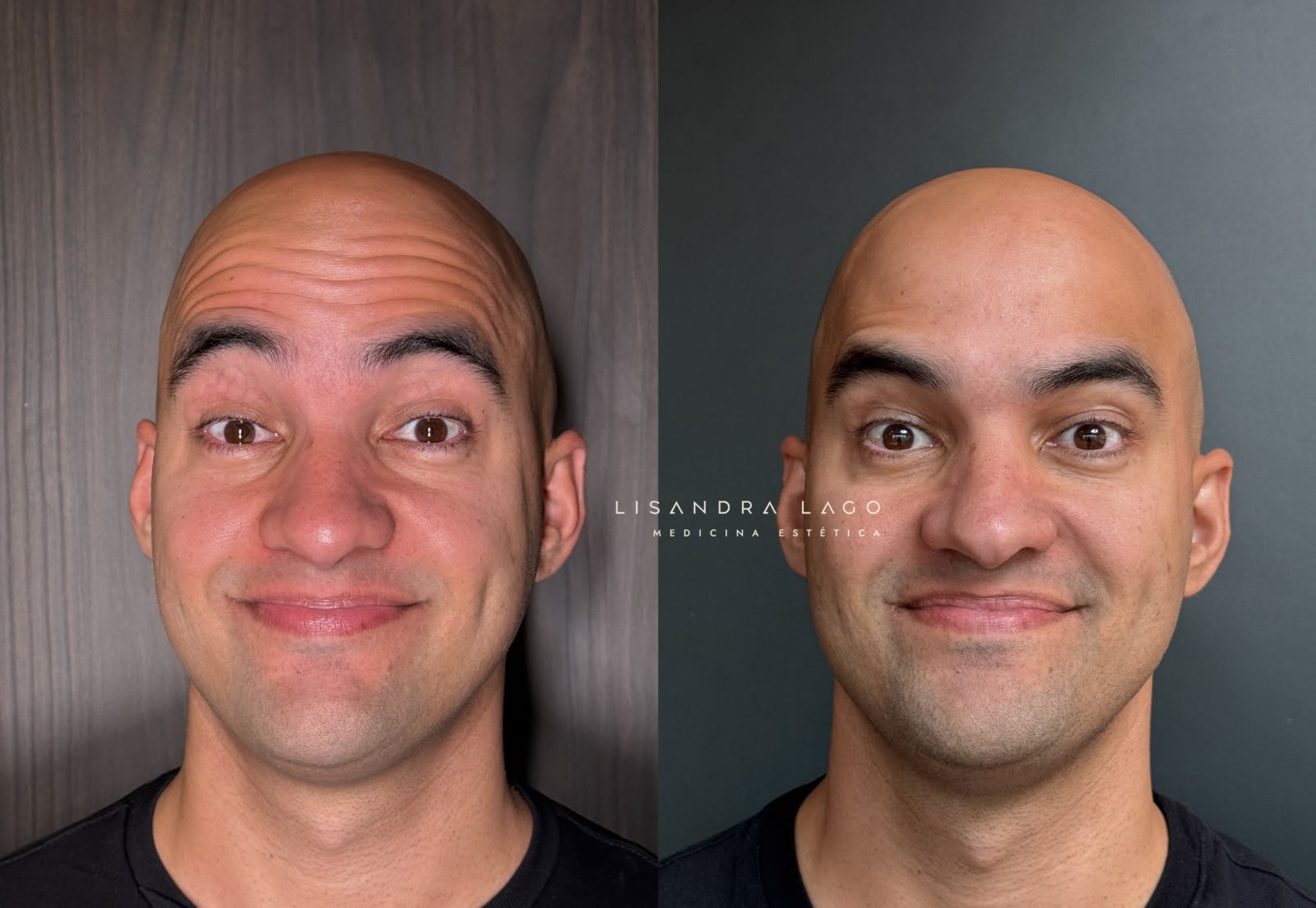Resultado de procedimento estético facial